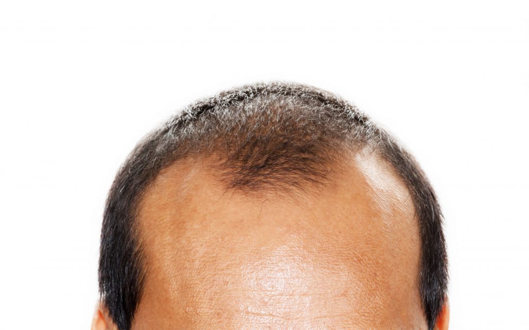 Greffe de cheveux pas cher : 6 bonnes raisons de vous méfier