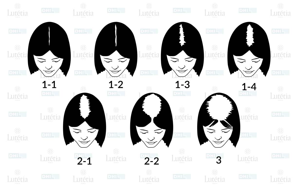 illustration stades alopécie femme Calvitie chez la femme | L'echelle de ludwig chez la femme | DHI Paris