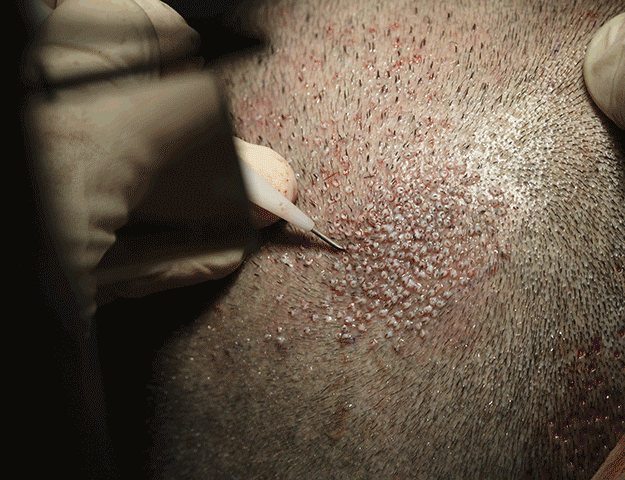 Le médecin implante les follicules puis procède au design capillaire L’art de la greffe de cheveux avec la Méthode DHI - Les étapes de l'intervention avec le design capillaire