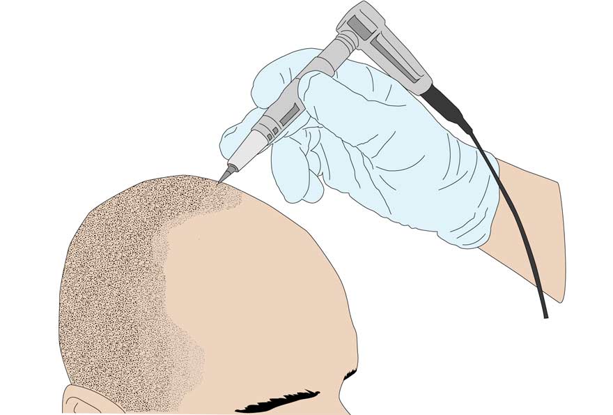 1ère étape de la micropigmentation du cuir chevelu