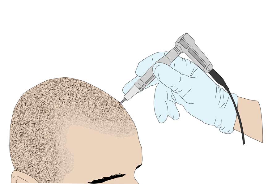 2ème étape de la micropigmentation du cuir chevelu