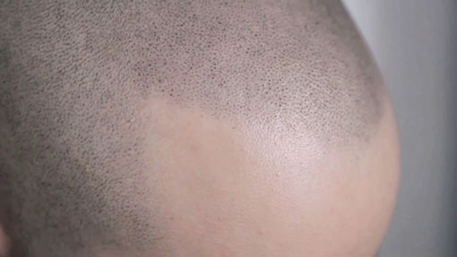 crâne avec de la micropigmentation La micropigmentation - du cuir chevelu