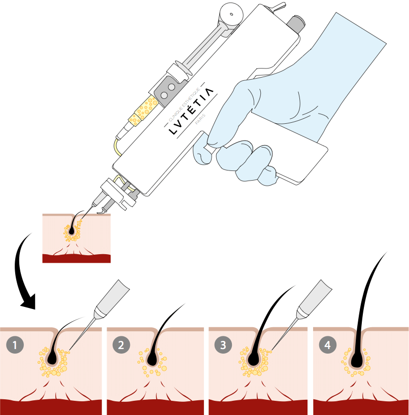 illustration d'une injection de PRP Injections de PRP avec le pistolet à mésothérapie