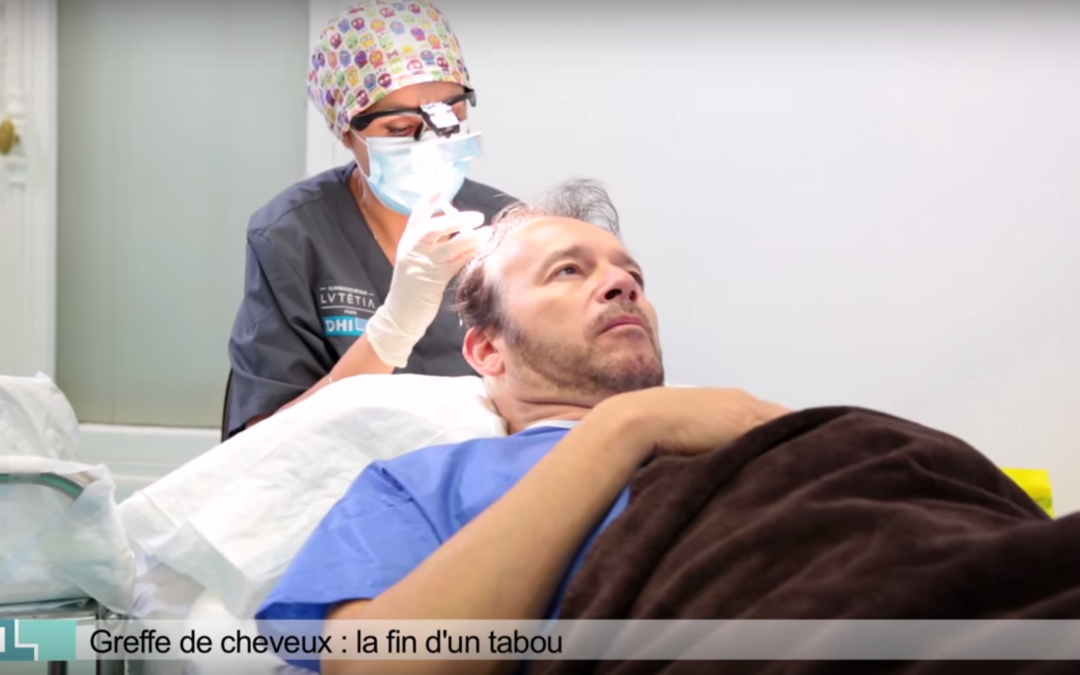 Les implants de cheveux de Jean-Michel Maire en vidéos