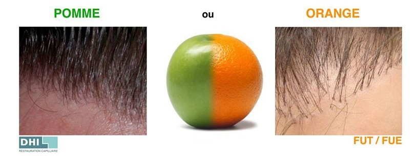 Greffe de cheveux : pomme ou orange ?