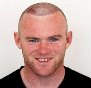 la calvitie de wayne rooney expliqu 233 e dhi france la calvitie de wayne rooney expliqu 233 e dhi france