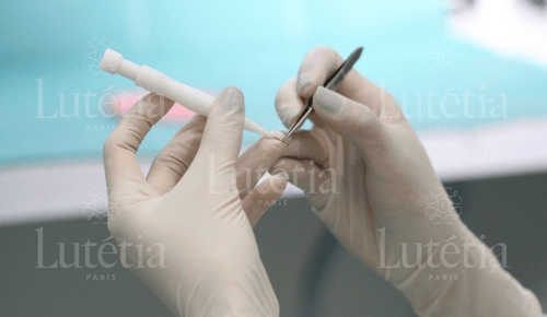 Portrait d'un homme souriant mesotherapie et LED pour traiter l'alopécie