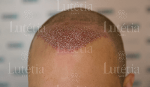 Portrait d'un homme souriant La greffe de cheveux - mesotherapie et LED pour traiter l'alopécie