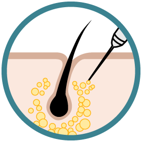 Mésothérapie du cuir chevelu