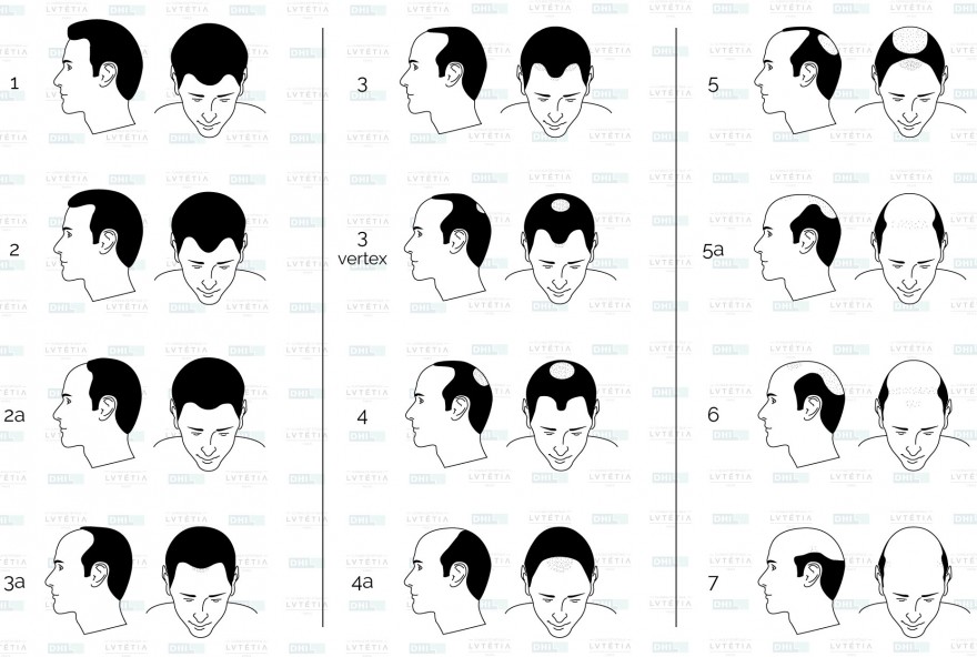 En savoir plus sur l’échelle de Norwood-Hamilton : Stade et évolution de la calvitie