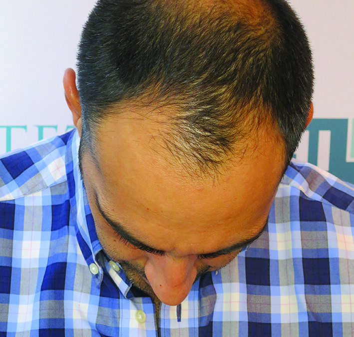 patient avant greffe cheveux DHI
