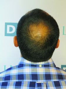patient avant greffe cheveux DHI