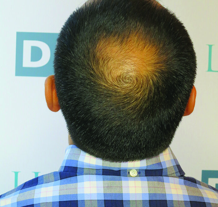 patient avant greffe cheveux DHI