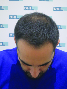 patient après greffe cheveux DHI