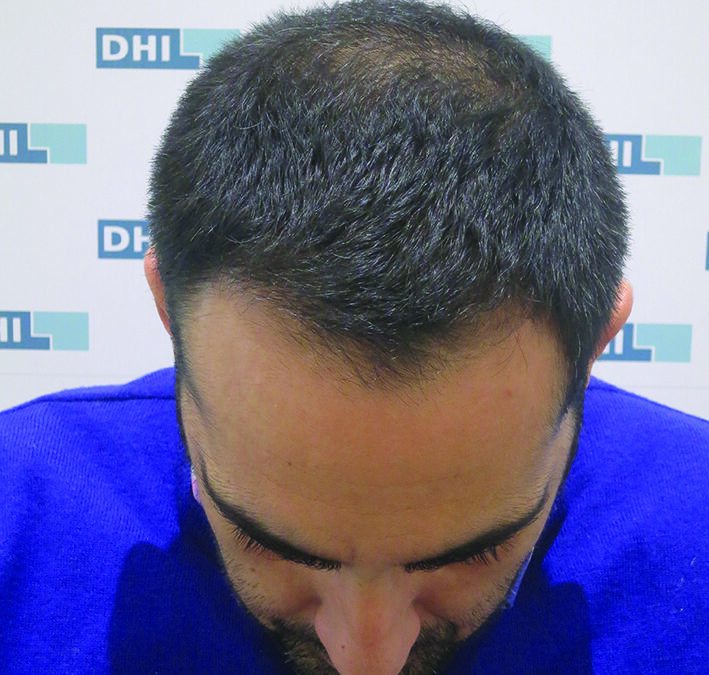 patient après greffe cheveux DHI