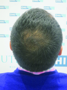 patient après greffe cheveux DHI
