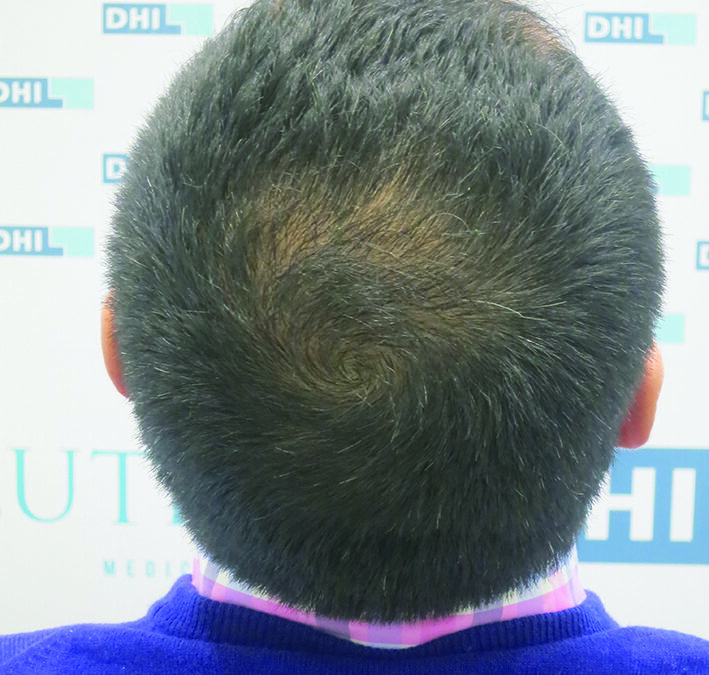 patient après greffe cheveux DHI