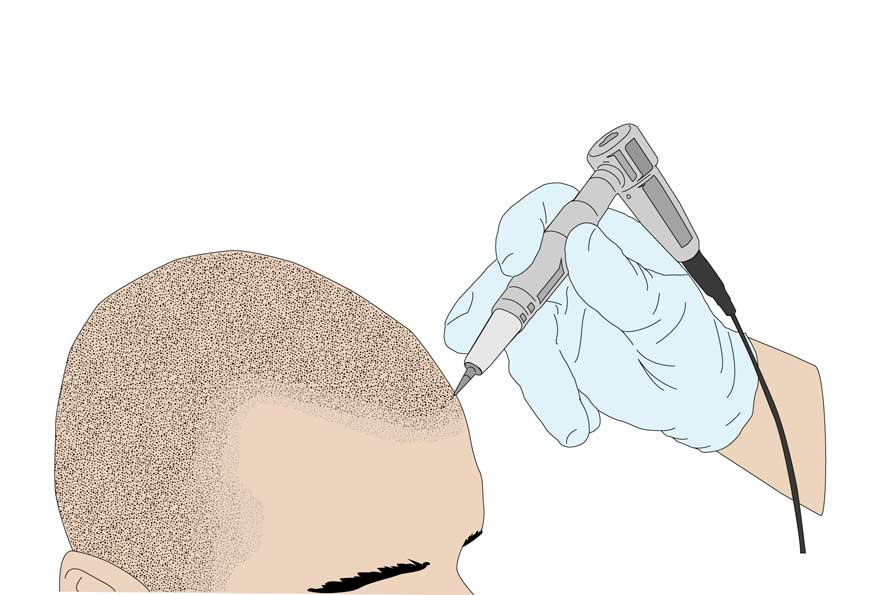 3ème étape de la micropigmentation du cuir chevelu
