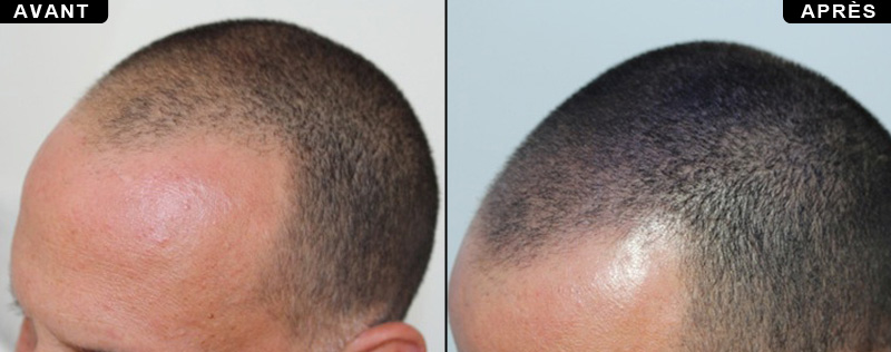 la micro-pigmentation du cuir chevelu avant après