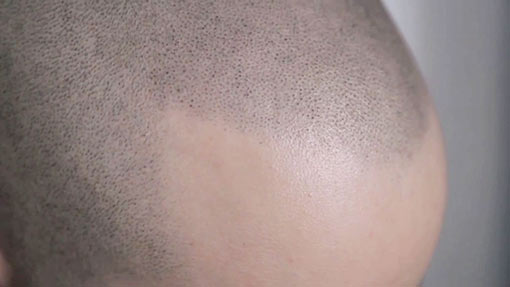 La micropigmentation - du cuir chevelu