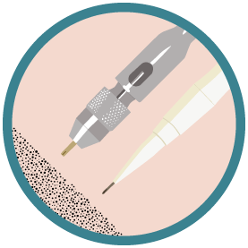 Méthode DHI - Illustration de l’implanteur et du punch DHI