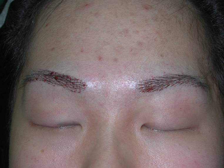 DHI-Eyebrows-Result-1-After