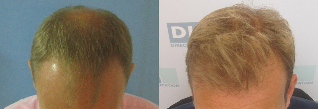 avant après greffe cheveux DHI