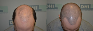 Résultat avant après micropigmentation des cheveux homme