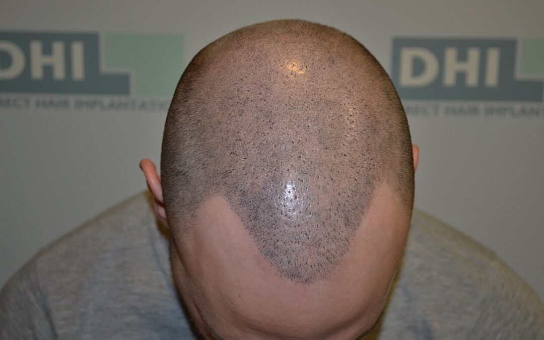 photo tête après trataiment micropigmentation DHI
