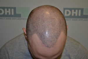 photo tête après trataiment micropigmentation DHI