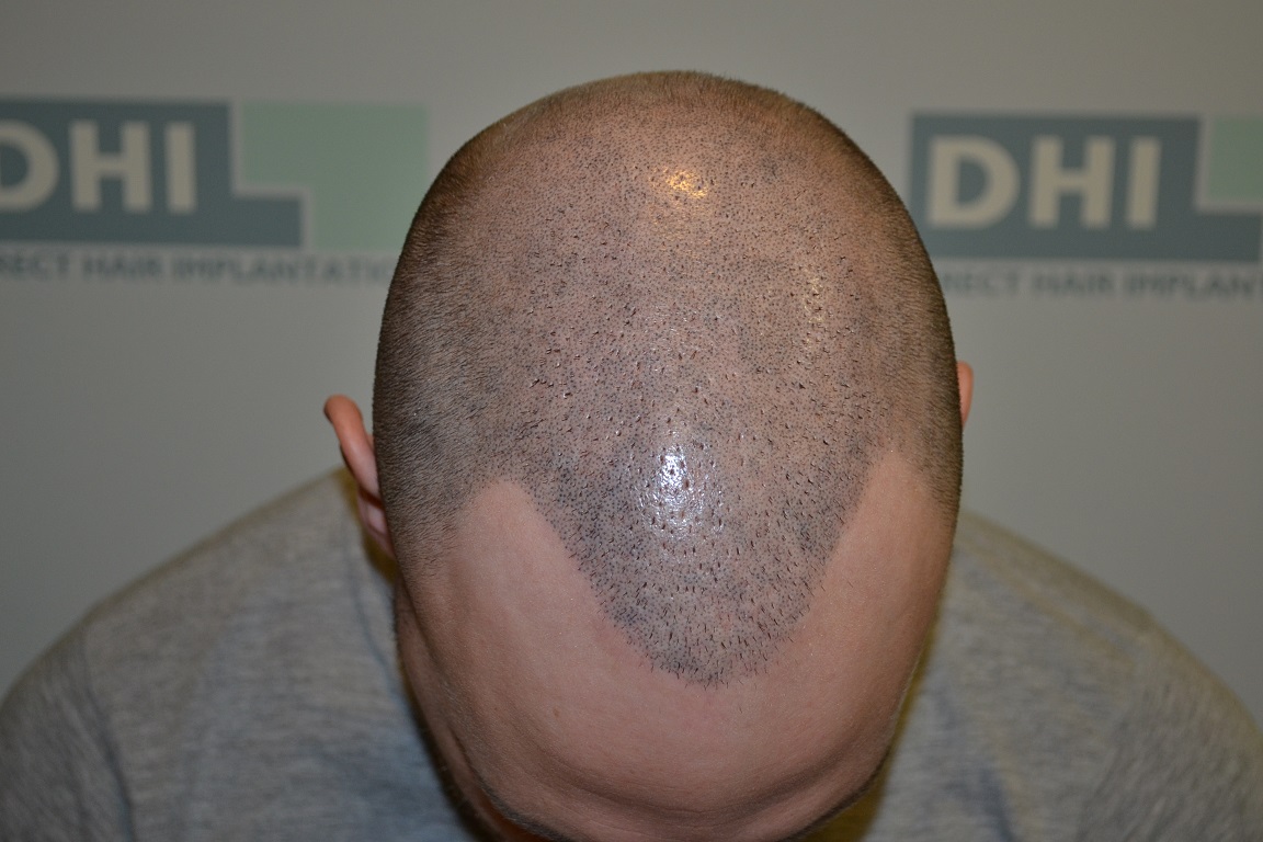 Is It Possible To Wear a Hat After The Scalp Micropigmentation?