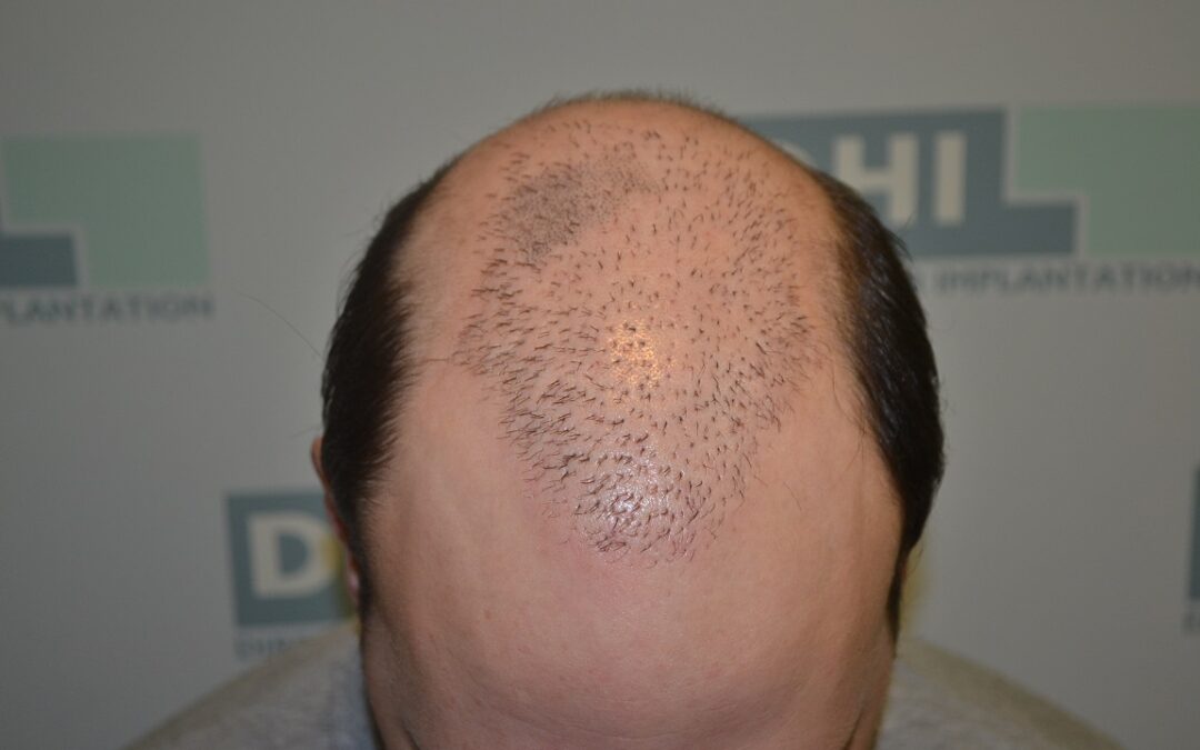 photo tête après trataiment micropigmentation DHI