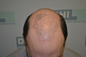 photo tête après trataiment micropigmentation DHI