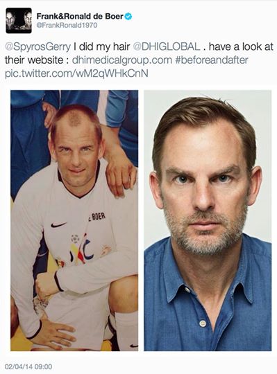 La greffe de cheveux de Ronald de Boer