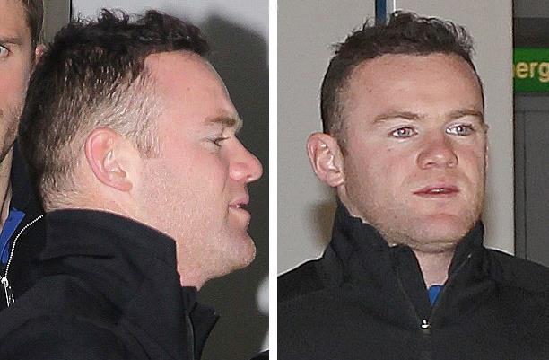 La greffe de cheveux de Wayne Rooney