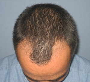 patient après greffe de cheveux DHI