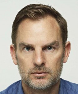 Ronald-De-Boer- Cheveux- Transplantation- Avant-1