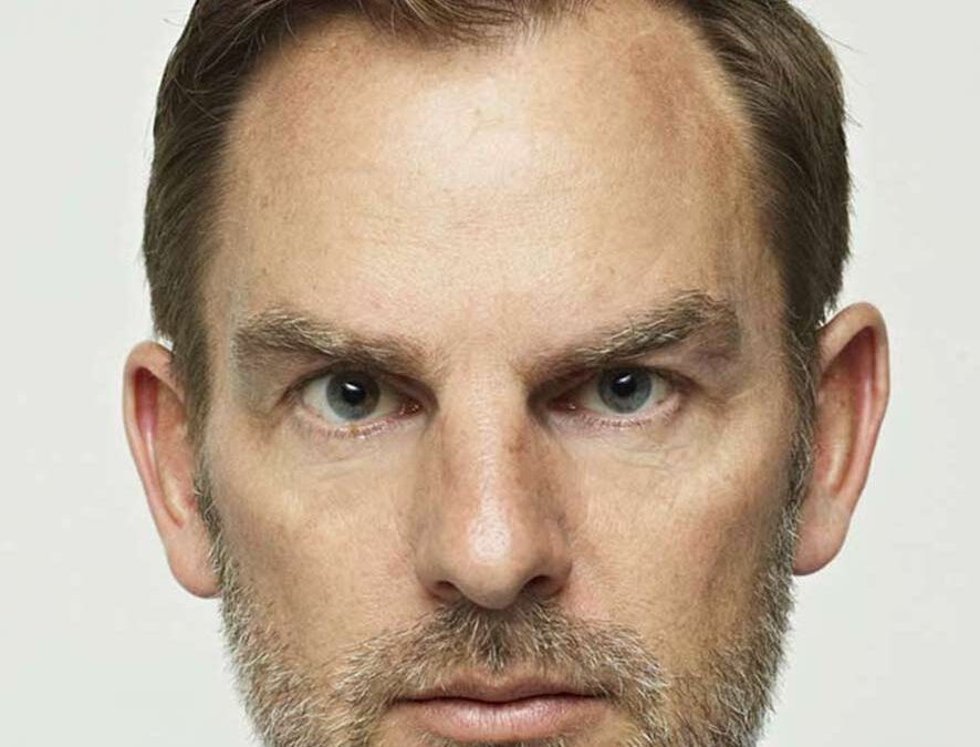 Ronald-De-Boer- Cheveux- Transplantation- Avant-1