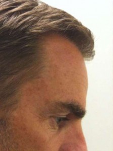 Ronald-De-Boer- Cheveux- Transplantation- Avant-3