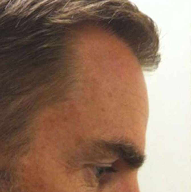 Ronald-De-Boer- Cheveux- Transplantation- Avant-3
