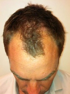 Ronald-De-Boer-Hair-Transplant-Before