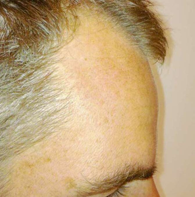 Ronald-De-Boer- Cheveux- Transplantation- Avant-3