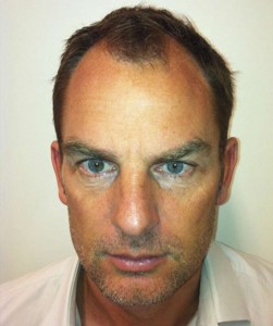 Ronald-De-Boer-Hair-Transplant-Before-4