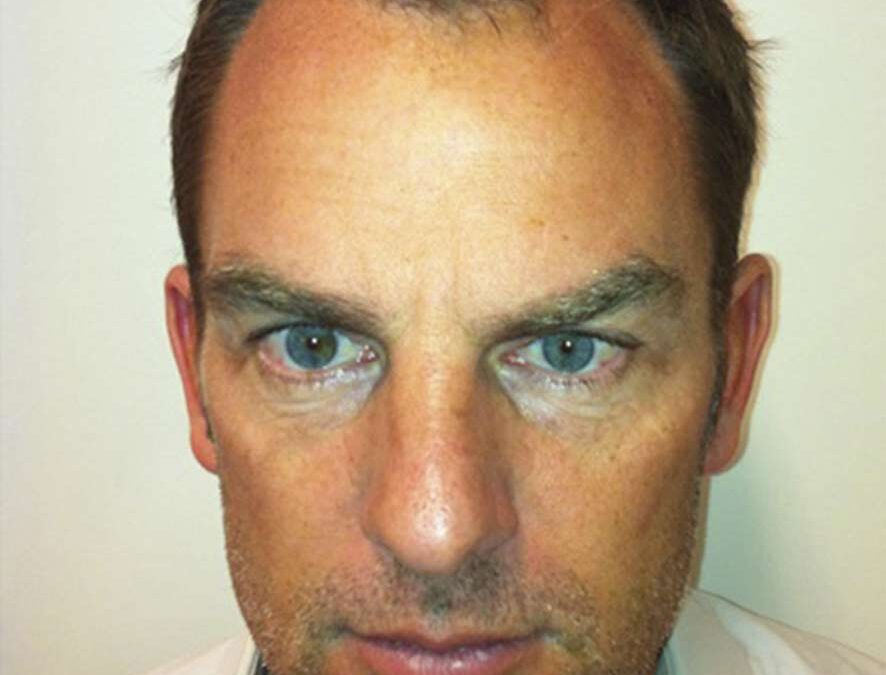 Ronald-De-Boer-Hair-Transplant-Before-4