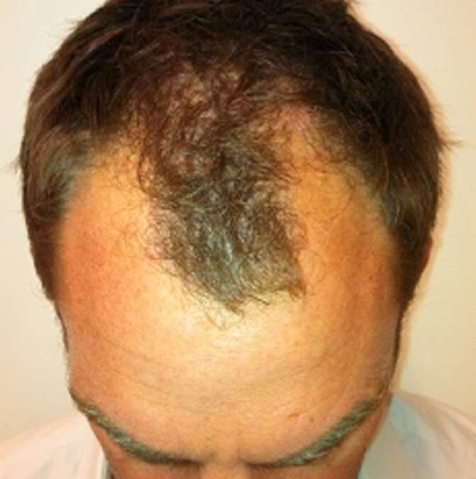 Ronald-De-Boer-Hair-Transplant-Before