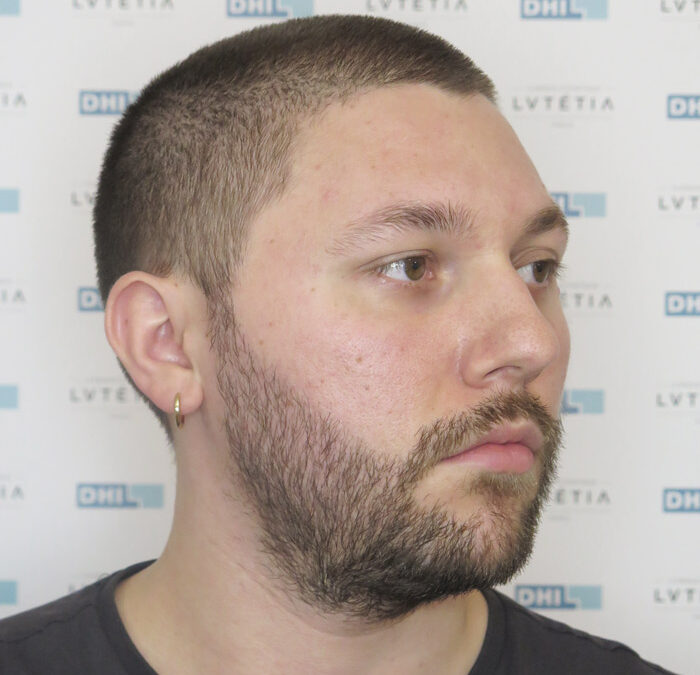 patient DHI greffe de barbe