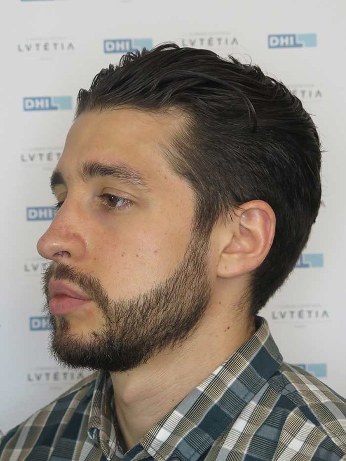 2016.07-DHI-patient-33-greffe-barbe-profil-gauche-apres