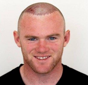 Wayne Rooney après sa greffe de cheveux avec DHI