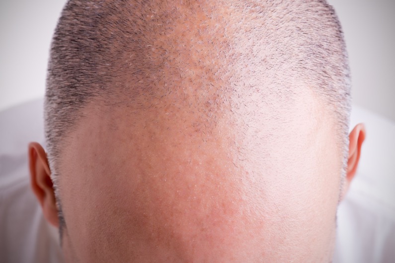 La croissance des cheveux stimulée grâce aux cellules souches