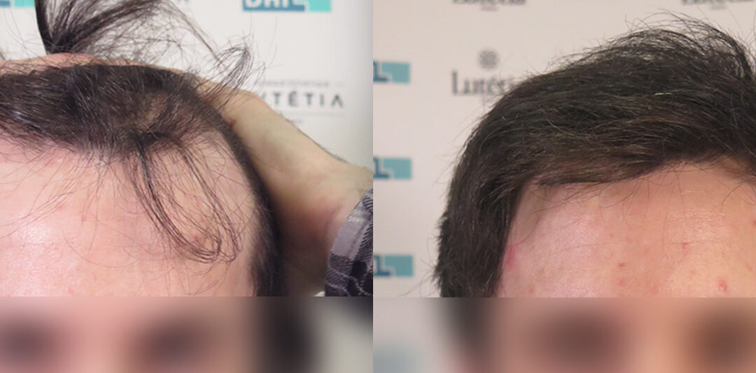 patient avant après greffe de cheveux DHI